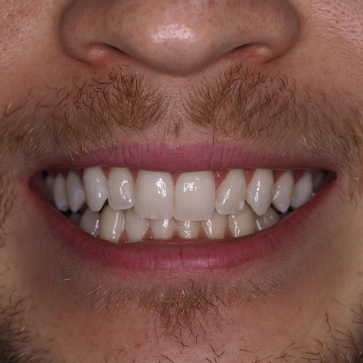 After image
