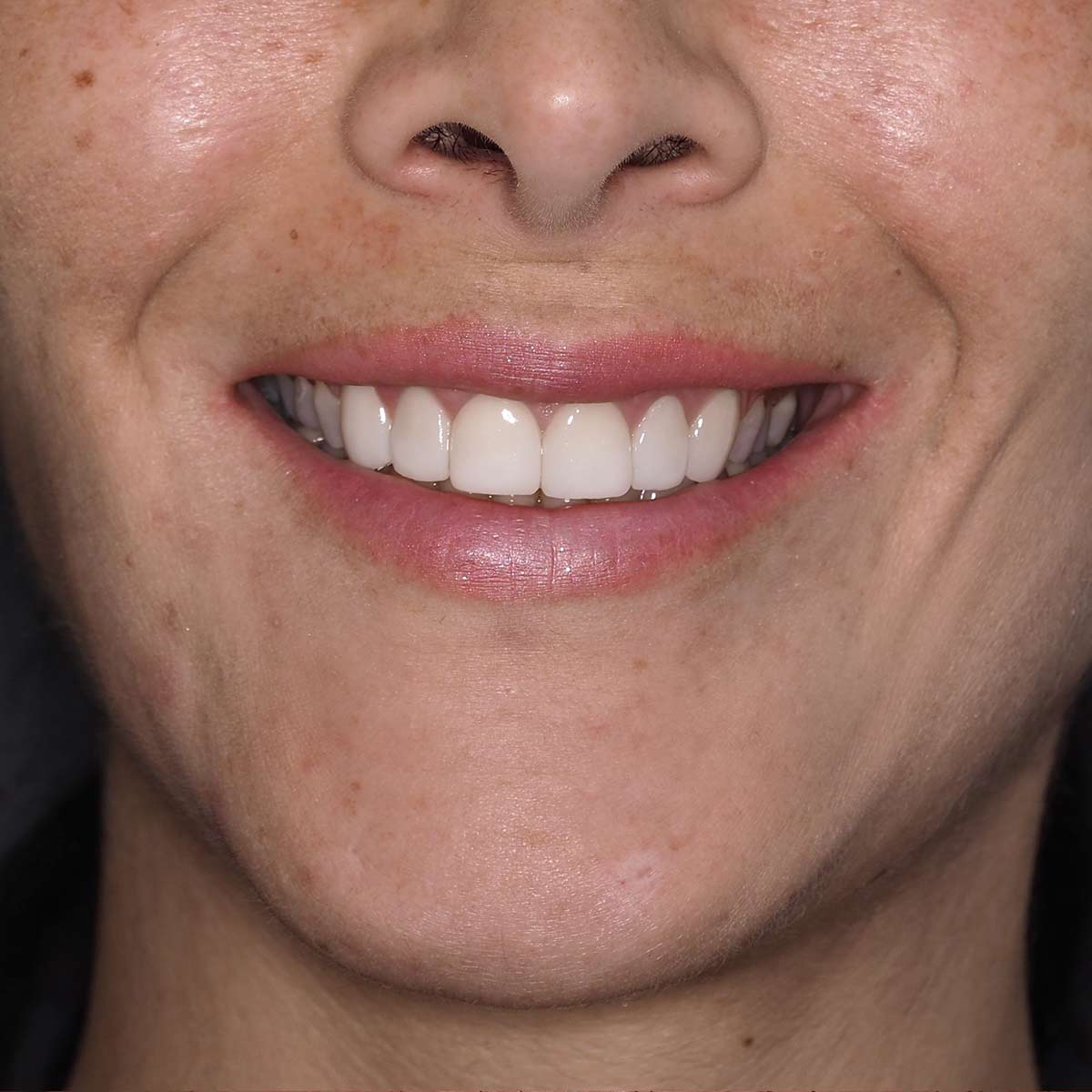 After image