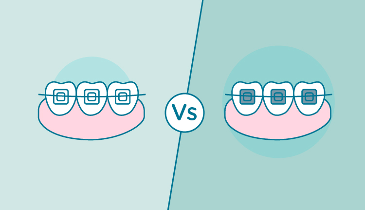 brackets-metalicos-esteticos