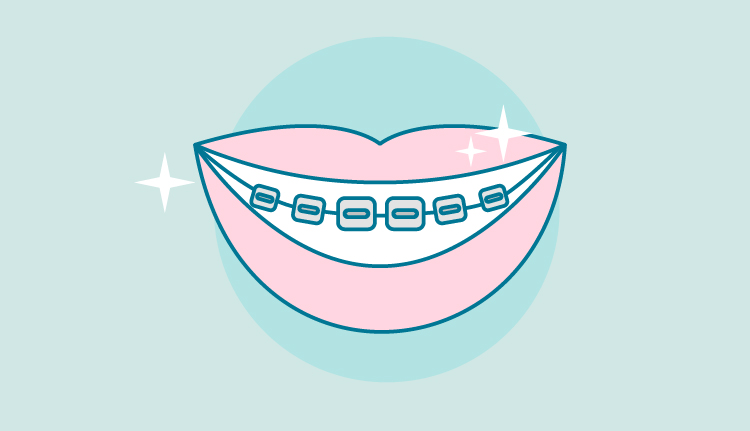 como-cuidar-brackets