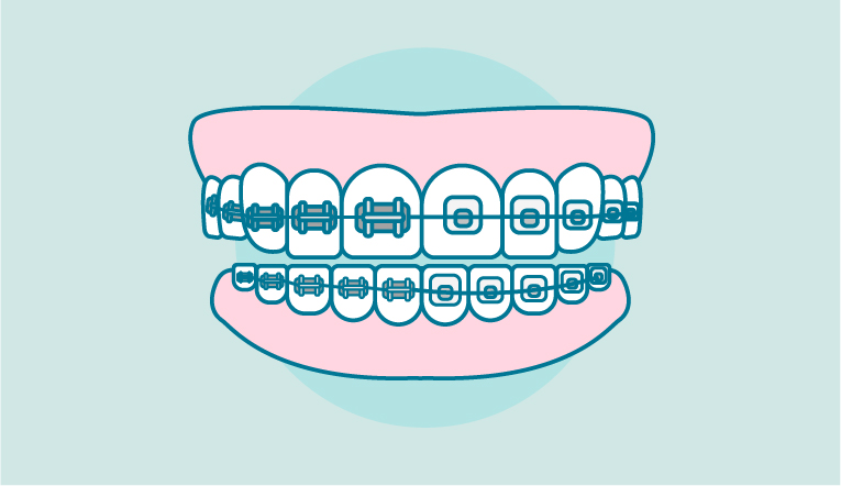 tipos-brackets-metalicos
