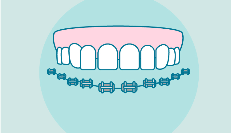 Brackets metálicos