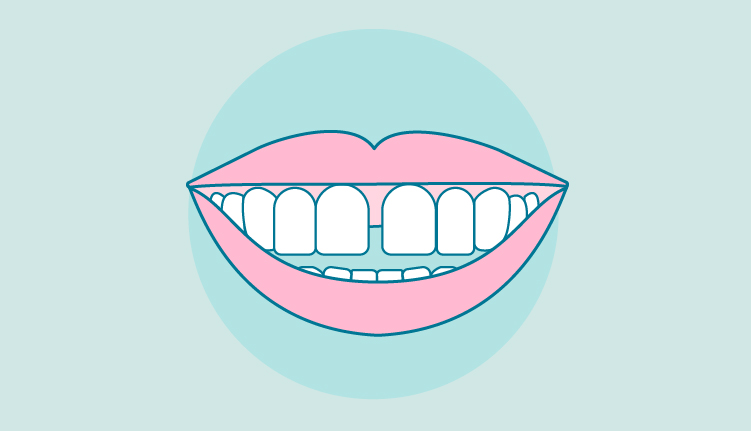 que-es-la-diastema|brackets-linguales|diastema