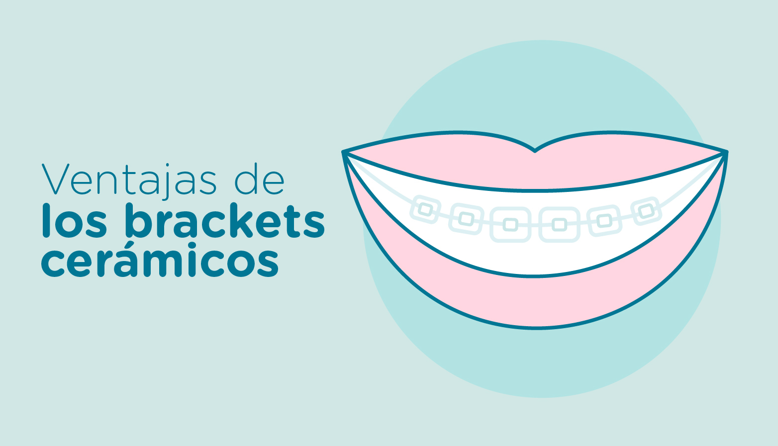 brackets-ceramicos|brackets-ceramicos