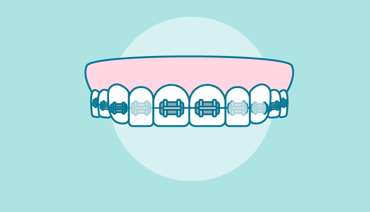 cera-para-brackets|