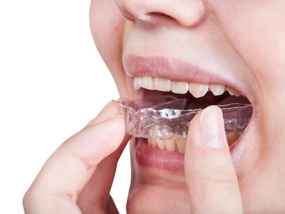 Férula dental Invisalign.|Estuche férula dental|Férula dental transparente