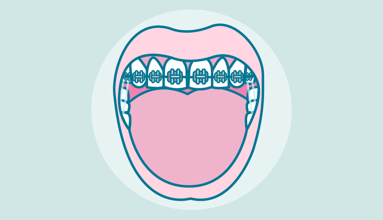 gomas-brackets