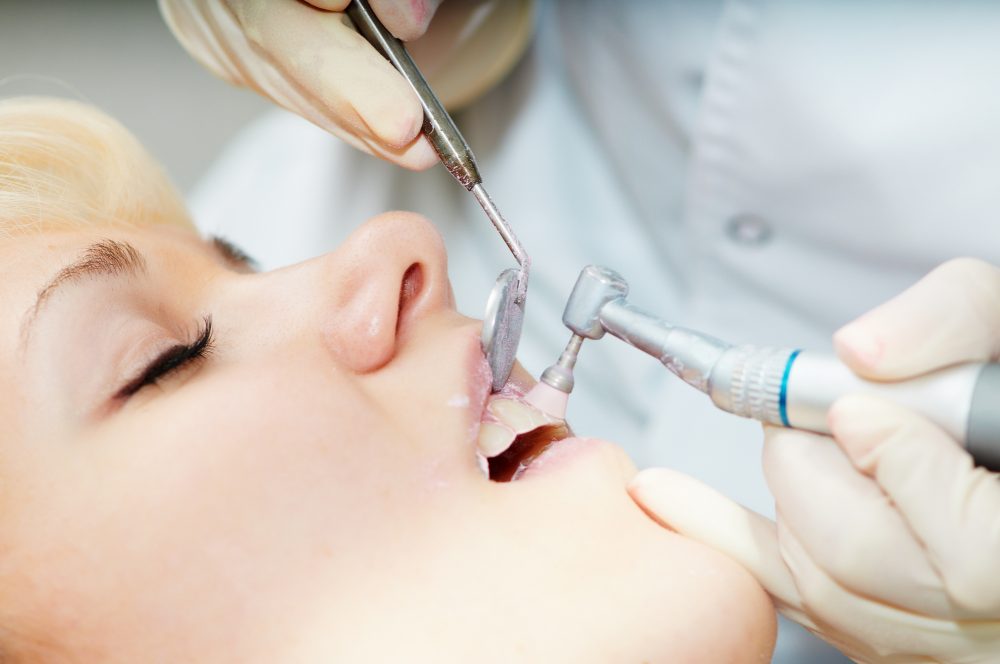 Cómo eliminar sarro de los dientes|Sarro y placa dental