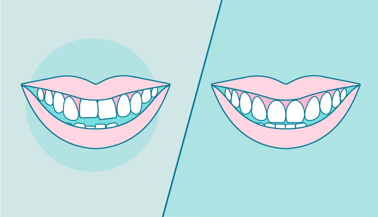 dientes-apiñados-antes-y-despues|ortodoncia-antes-y-despues-apiñamiento|ortodoncia-antes-y-despues