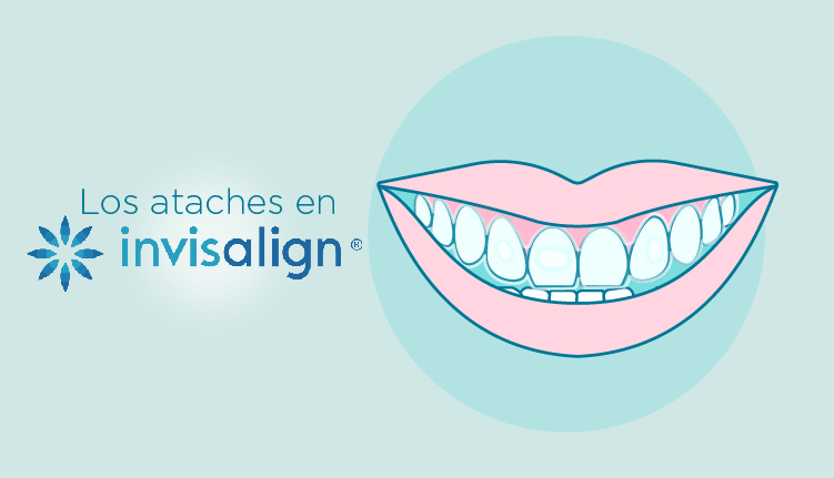 ataches-invisalign|ataches-invisalign