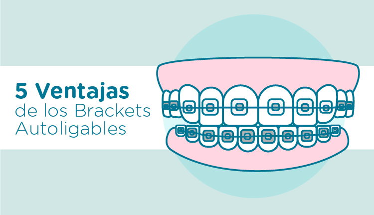 brackets autoligables Ventajas