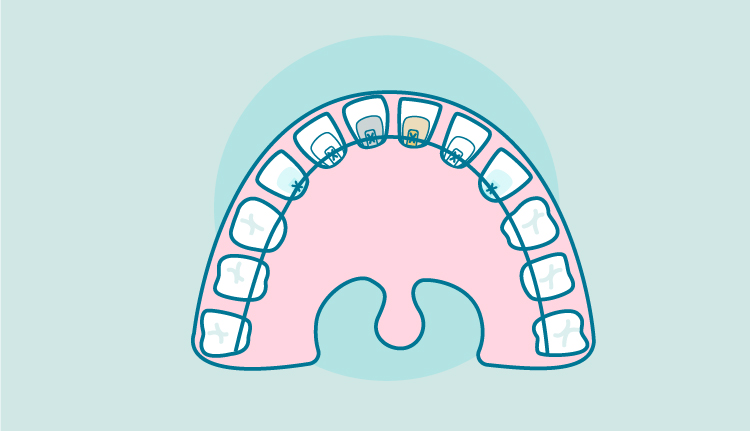 brackets-linguales|brackets-linguales2