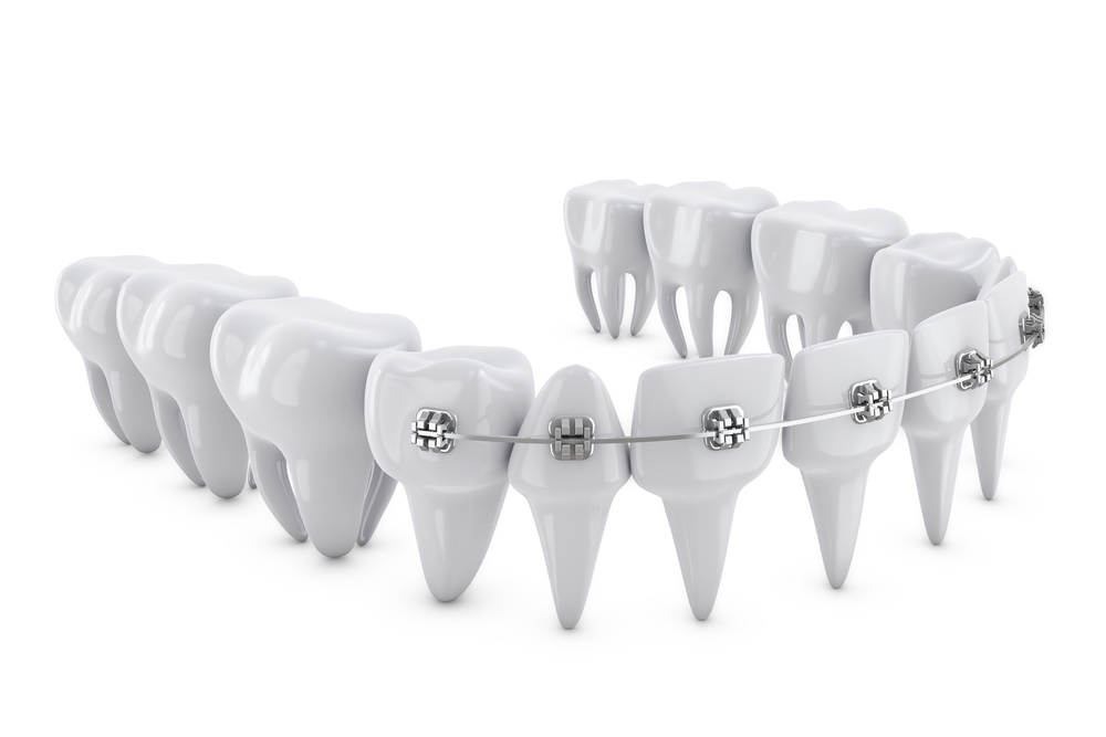 brackets para ortodoncia