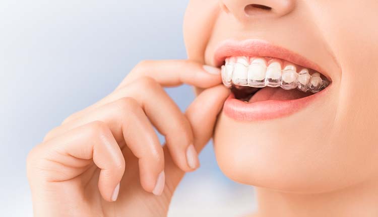 Invisalign Precio|invisalign-precio