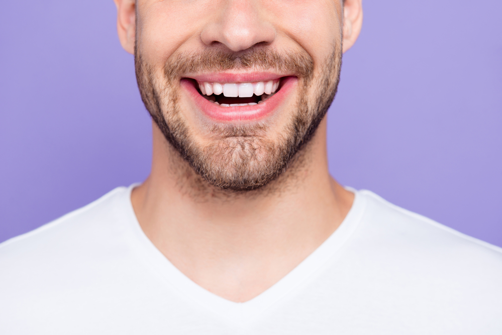 Boca de hombre con carillas dentales