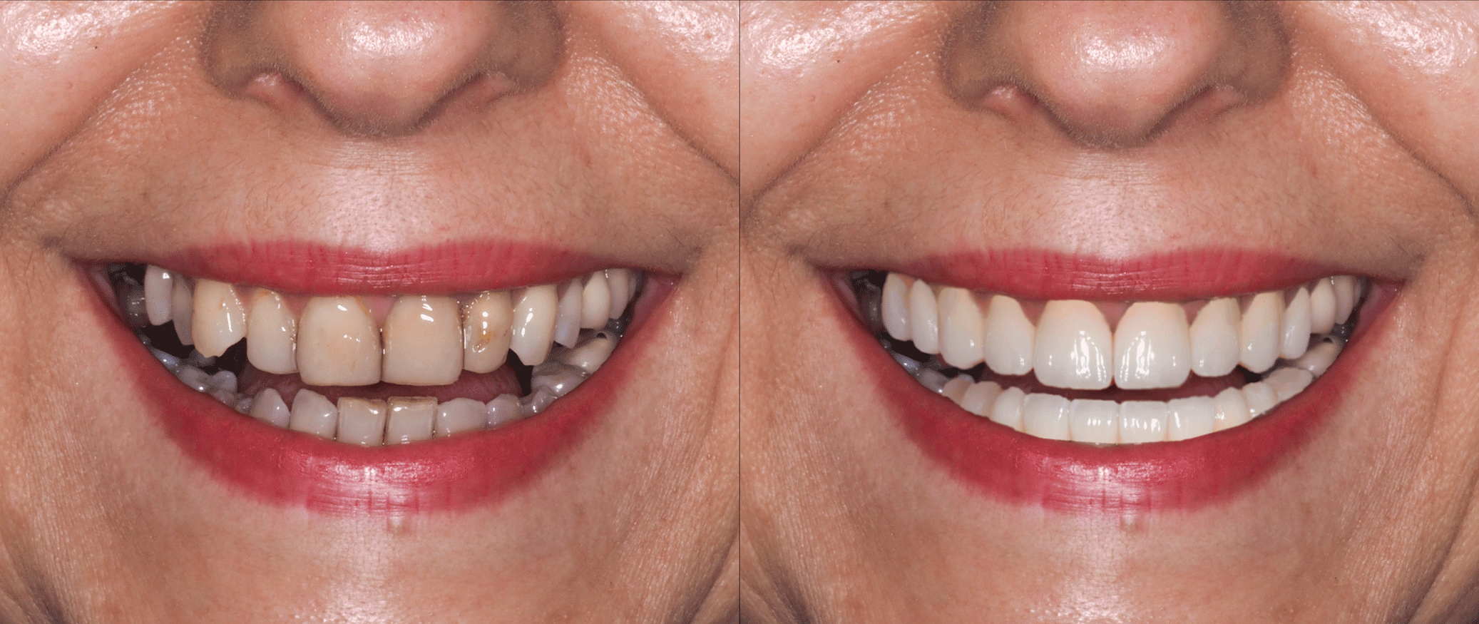 svmedical-diseno-sonrisa-caso-exito-1