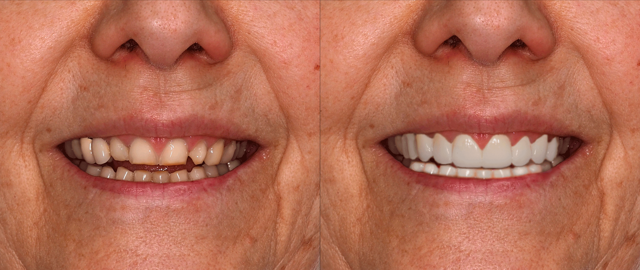 svmedical-diseno-sonrisa-caso-exito-2