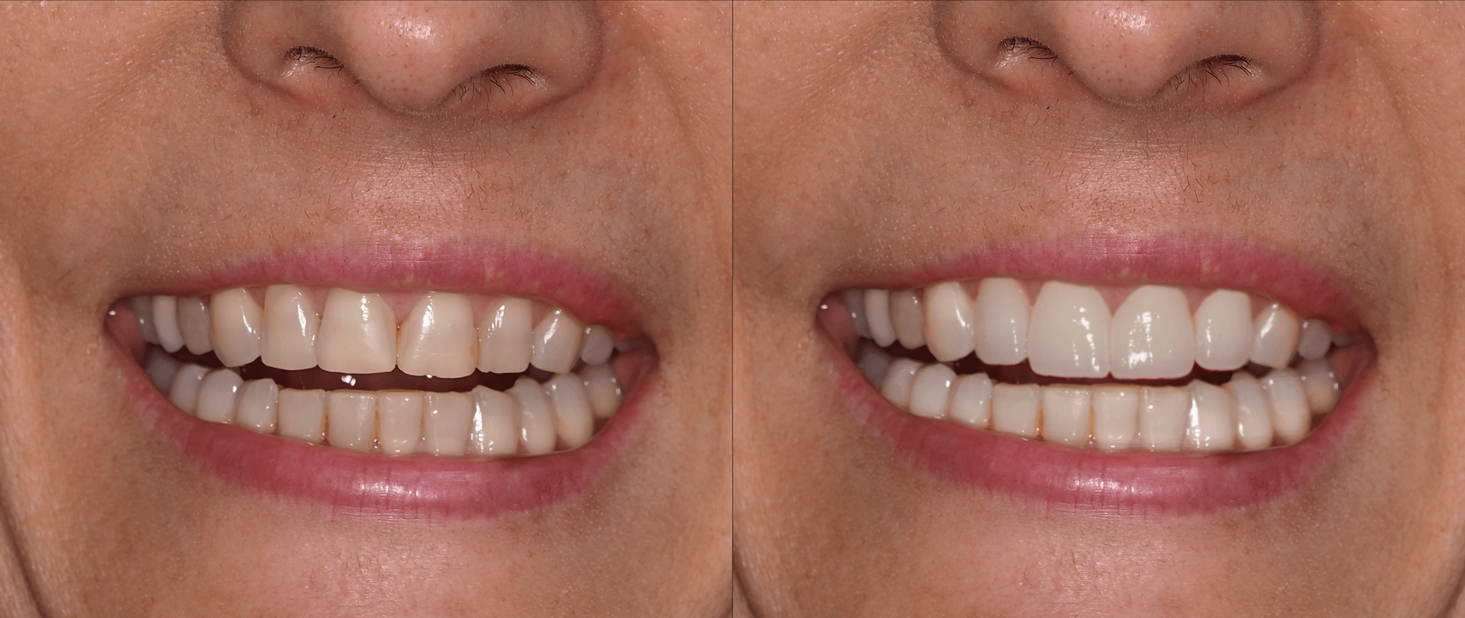 svmedical-diseno-sonrisa-caso-exito-3