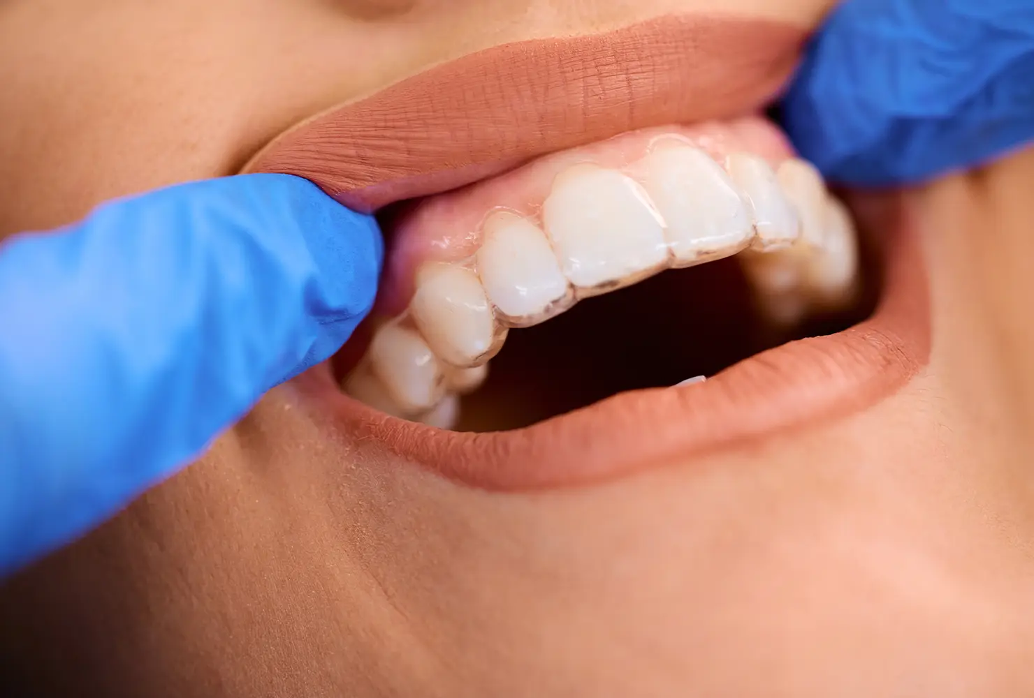 Spark vs Invisalign