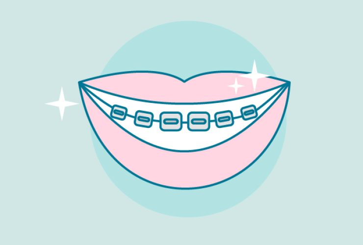 como-cuidar-brackets