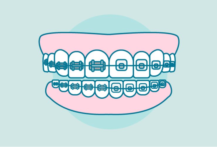 tipos-brackets-metalicos