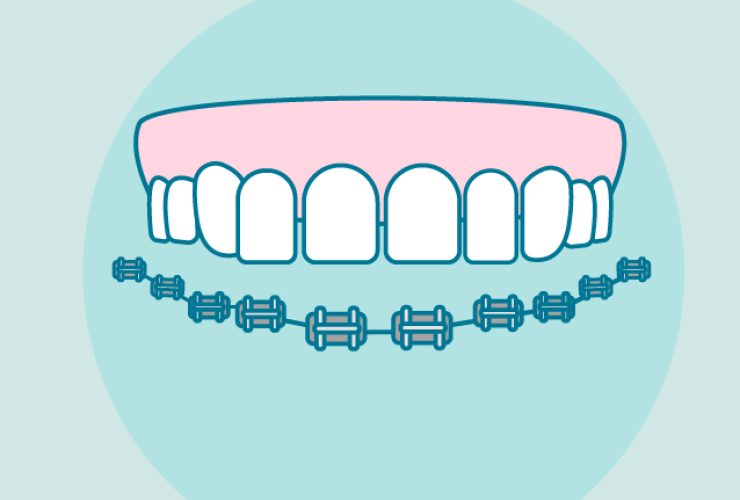 Brackets metálicos