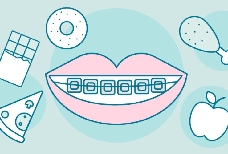 Qué puedo comer con brackets