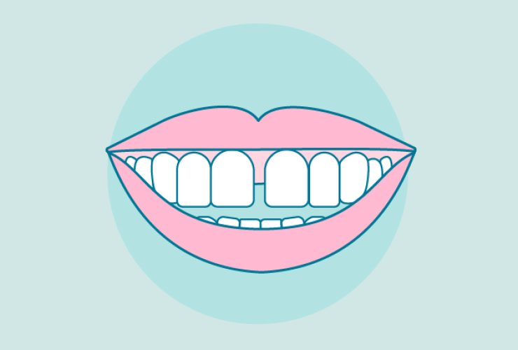 que-es-la-diastema|brackets-linguales|diastema