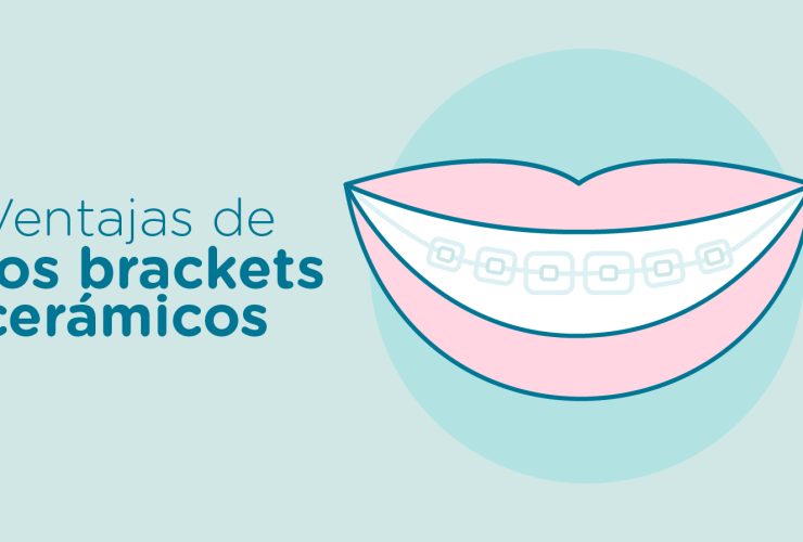 brackets-ceramicos|brackets-ceramicos