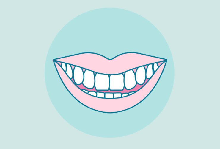 apiñamiento-dental