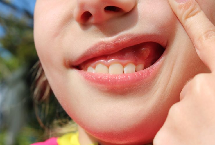 Bulto en la encía.|Paciente en consulta dentista