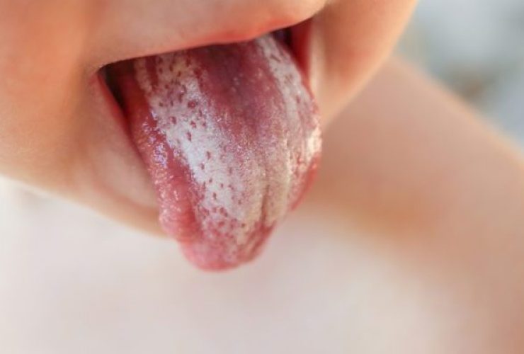 Lengua blanca por candidiasis|Lengua blanca|Tratamiento dental