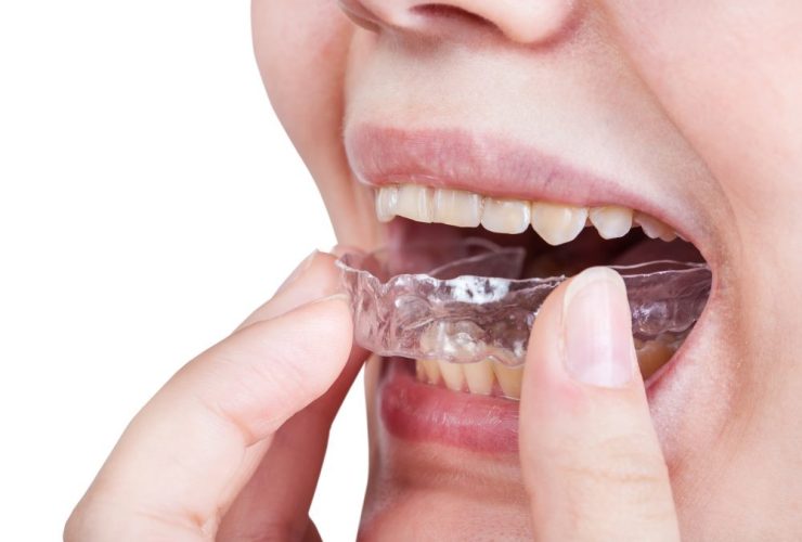 Férula dental Invisalign.|Estuche férula dental|Férula dental transparente
