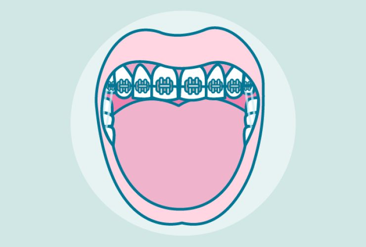 gomas-brackets