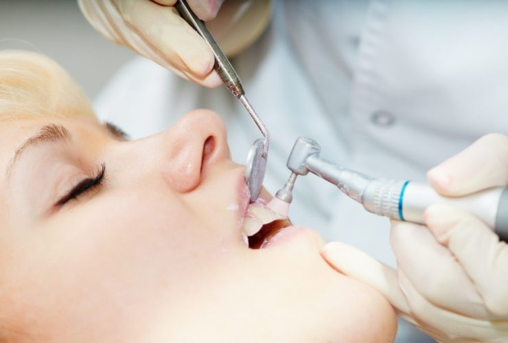 Cómo eliminar sarro de los dientes|Sarro y placa dental