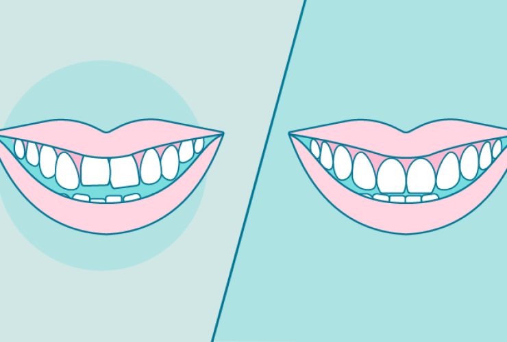 dientes-apiñados-antes-y-despues|ortodoncia-antes-y-despues-apiñamiento|ortodoncia-antes-y-despues