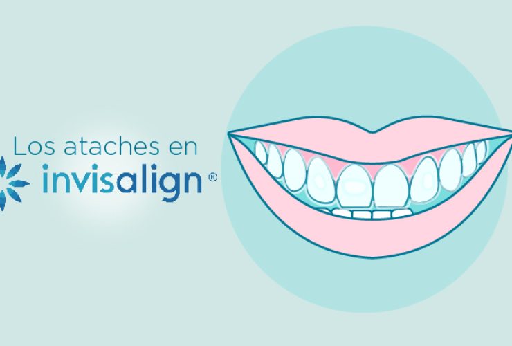 ataches-invisalign|ataches-invisalign
