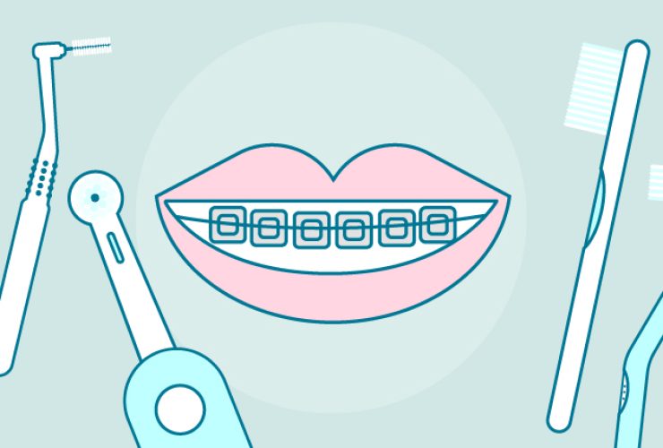 |cepillo-de-dientes-para-ortodoncia