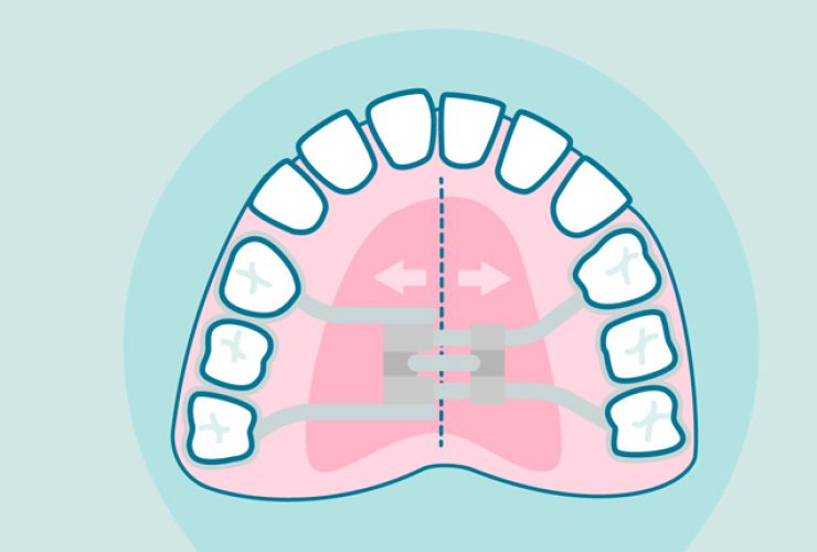 expansor-de-paladar|boca mordida|Explicacion disyuntor