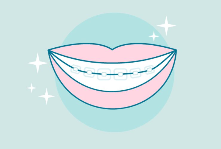 Tipos de brackets esteticos mas usados|tipos de brackets esteticos y metalicos|tipos de brackets autoligables esteticos