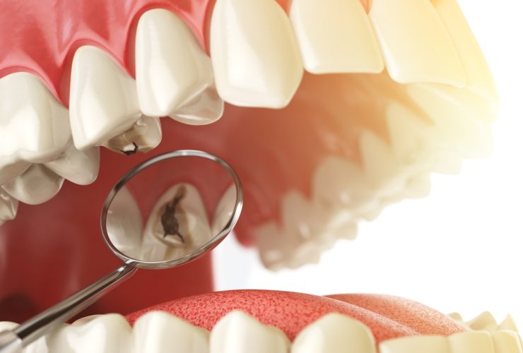 Dolor de muelas por muela con caries|Muela con caries. Dolor de muelas|muela infectada