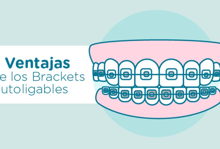 brackets autoligables Ventajas