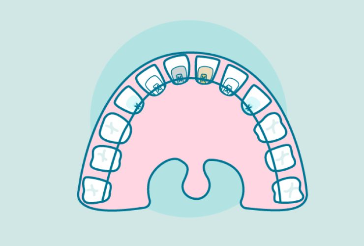 brackets-linguales|brackets-linguales2