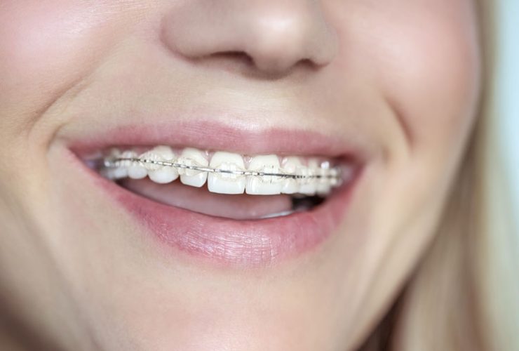 |Brackets transparentes
