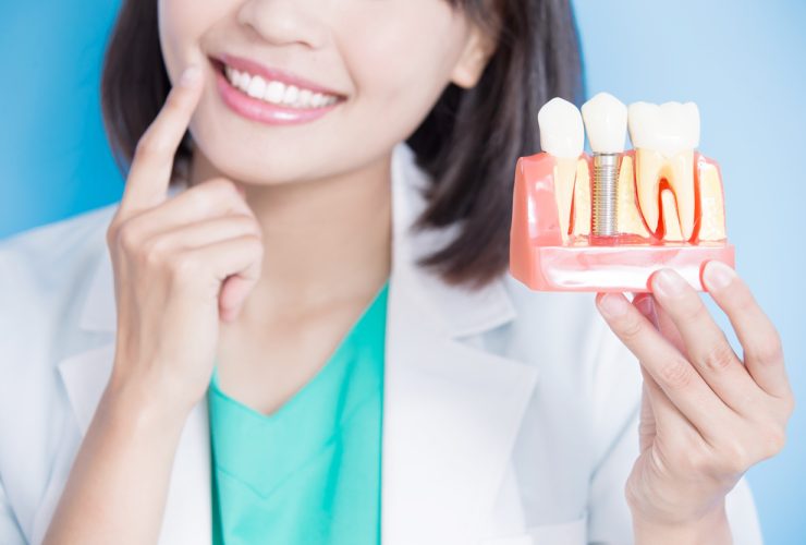 Mujer Dentista con ejemplo de implante dental y carillas