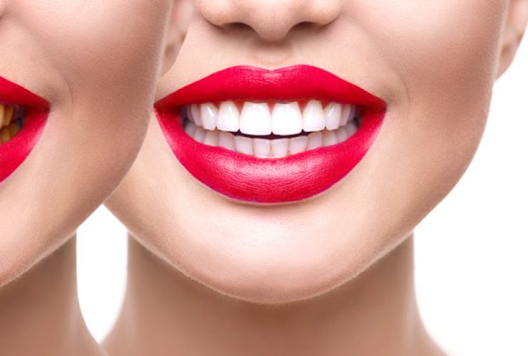coste del blanqueamiento dental|