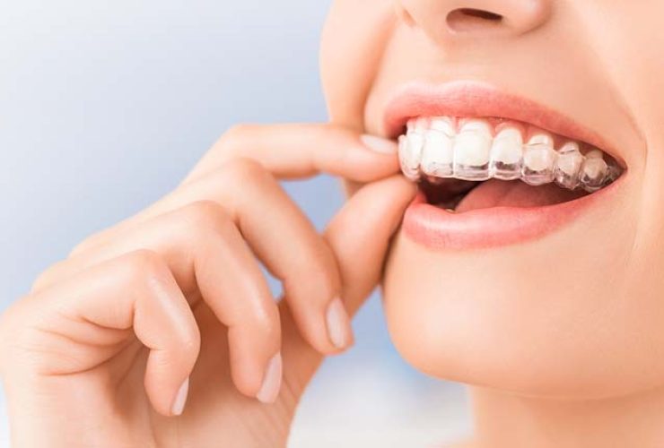Invisalign Precio|invisalign-precio